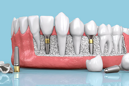 Costa Rica dental implants